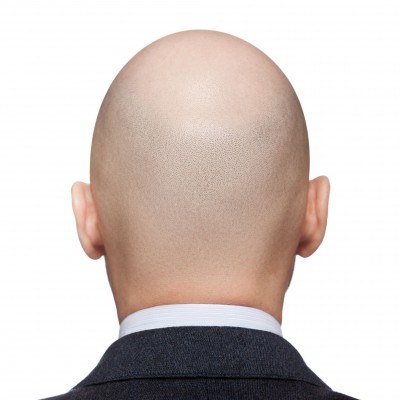 Bald-man